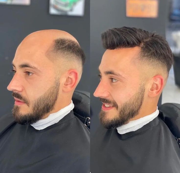 Men's Non-Surgical Hair System 003 - Darkest Brown (#1B)- Skin Base