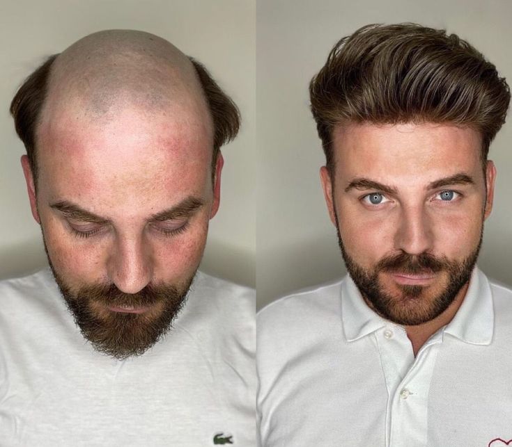 Men's Non-Surgical Hair System 009 - Ash Brown (#5) - Skin Base